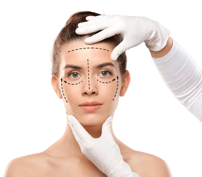Woman with facial treatment guide markings for aesthetic procedures.